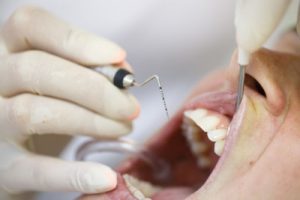 Root Canal Treatments