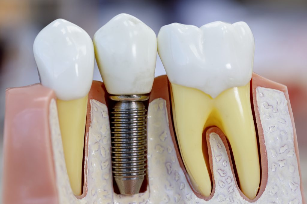 Dental Implants